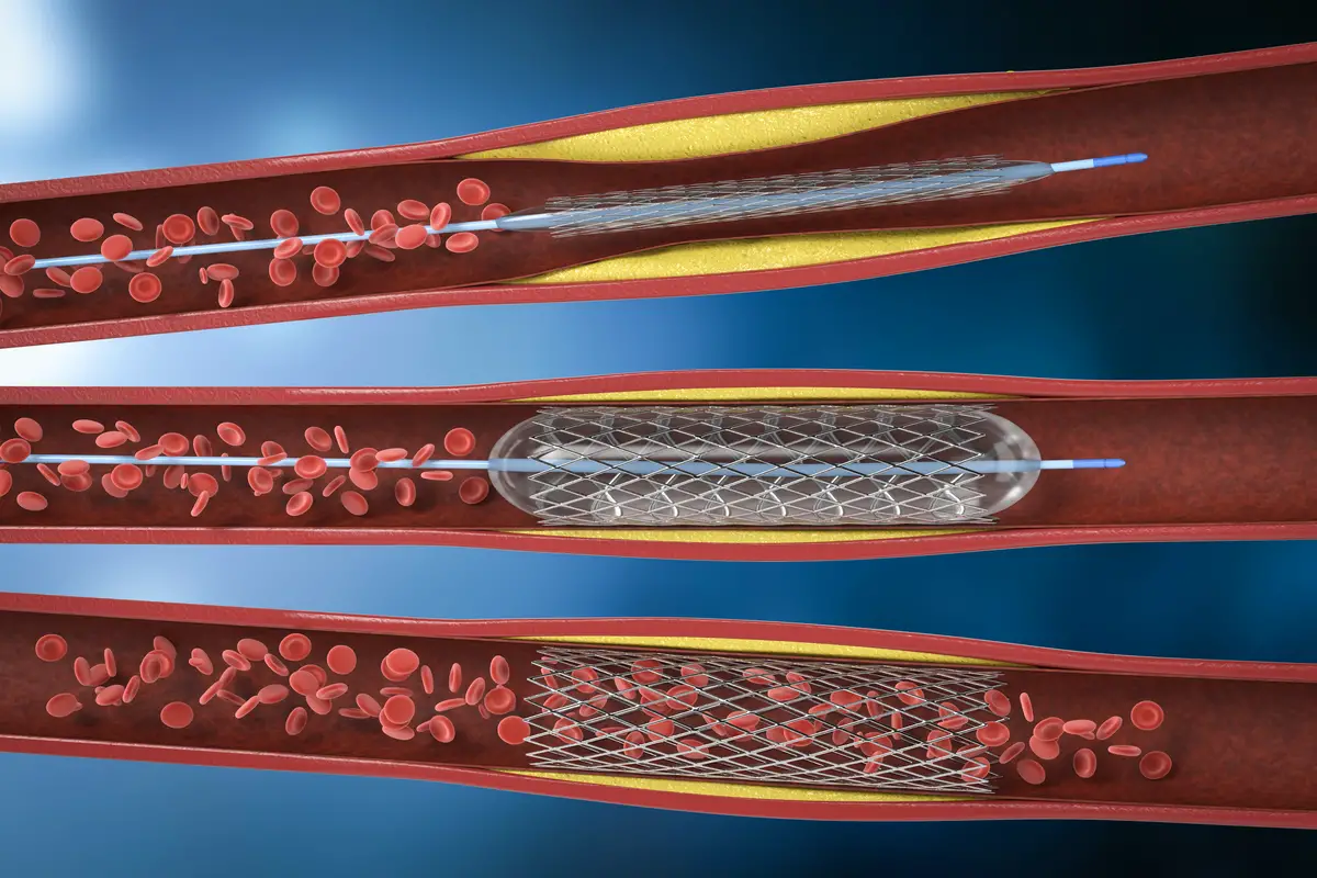 Angiography Hospital in Mumbai